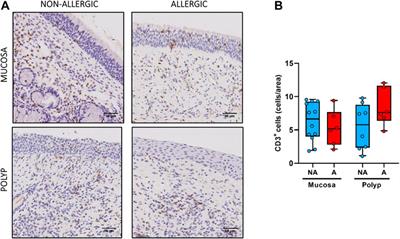 Understanding Systemic and Local Inflammation Induced by Nasal Polyposis: Role of the Allergic Phenotype